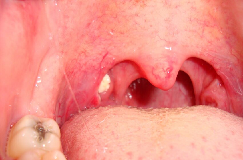  ¿Qué son los tonsilolitos y por qué provocan mal aliento?